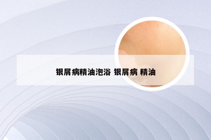 银屑病精油泡浴 银屑病 精油
