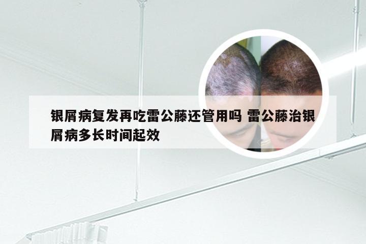 银屑病复发再吃雷公藤还管用吗 雷公藤治银屑病多长时间起效