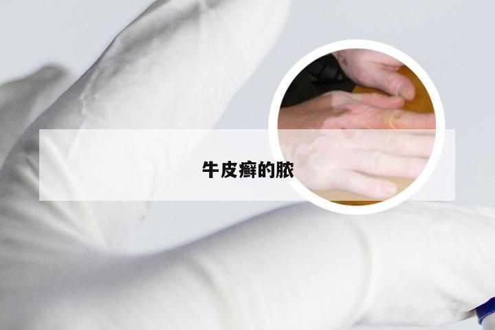 牛皮癣的脓