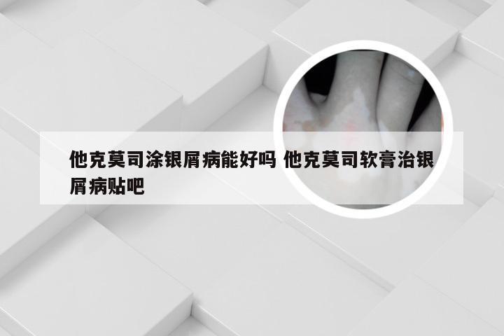 他克莫司涂银屑病能好吗 他克莫司软膏治银屑病贴吧