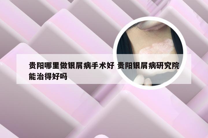 贵阳哪里做银屑病手术好 贵阳银屑病研究院能治得好吗