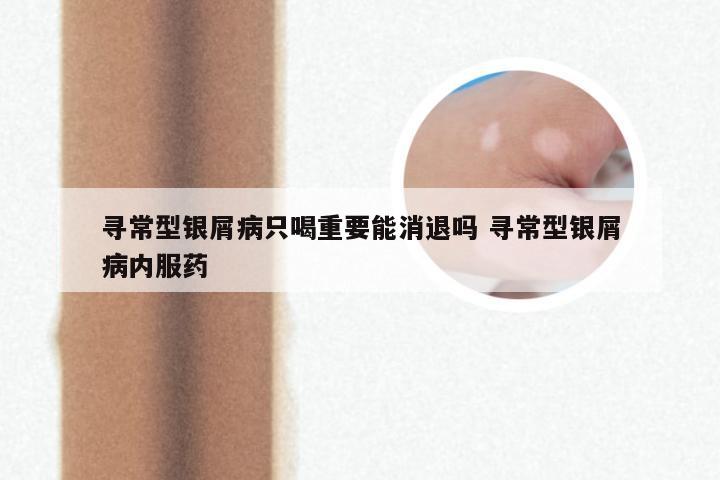寻常型银屑病只喝重要能消退吗 寻常型银屑病内服药