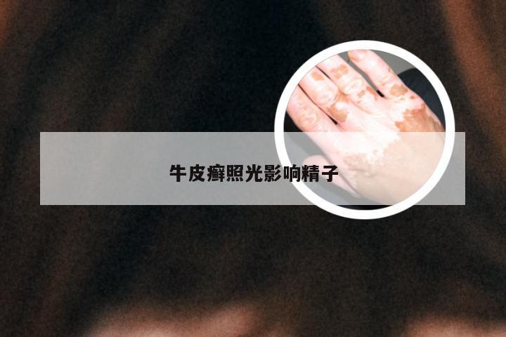 牛皮癣照光影响精子