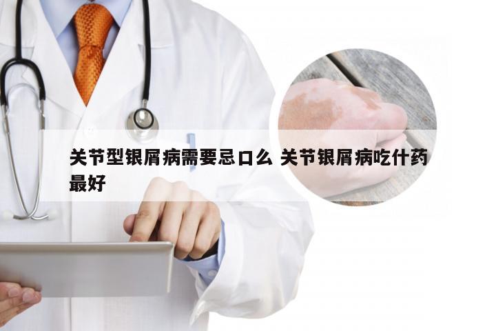 关节型银屑病需要忌口么 关节银屑病吃什药最好