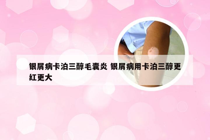 银屑病卡泊三醇毛囊炎 银屑病用卡泊三醇更红更大