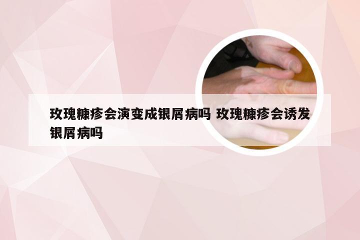 玫瑰糠疹会演变成银屑病吗 玫瑰糠疹会诱发银屑病吗