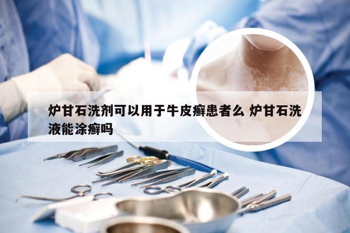 炉甘石洗剂可以用于牛皮癣患者么 炉甘石洗液能涂癣吗