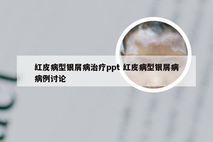 红皮病型银屑病治疗ppt 红皮病型银屑病病例讨论