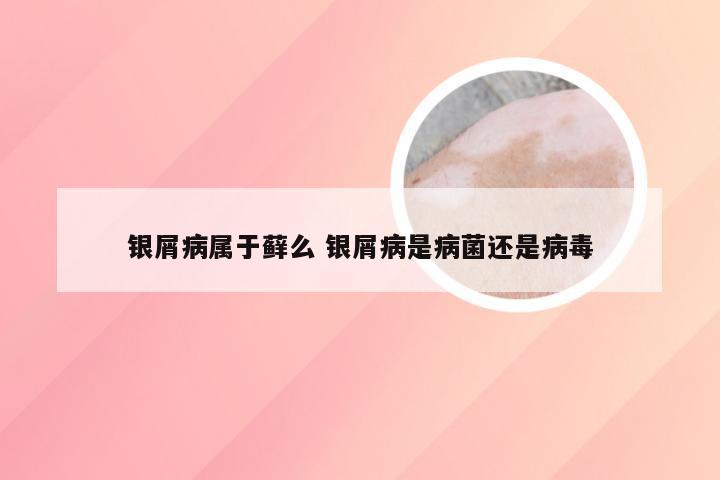 银屑病属于藓么 银屑病是病菌还是病毒