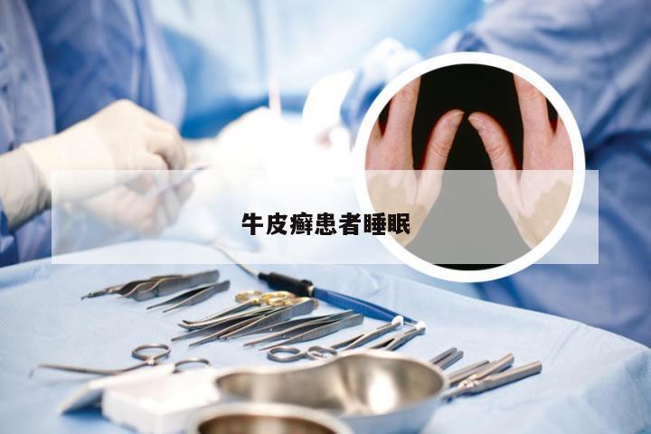 牛皮癣患者睡眠