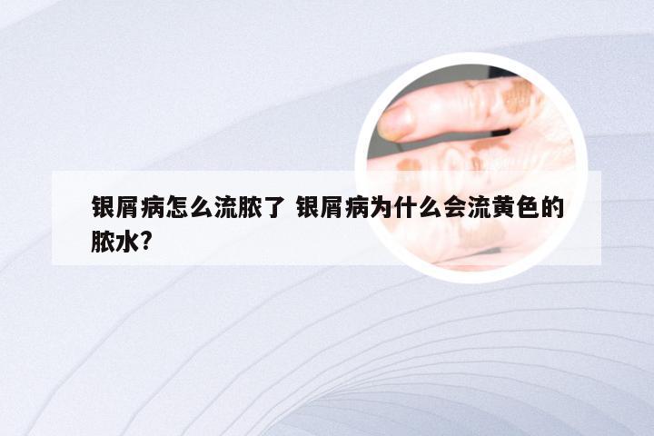 银屑病怎么流脓了 银屑病为什么会流黄色的脓水?