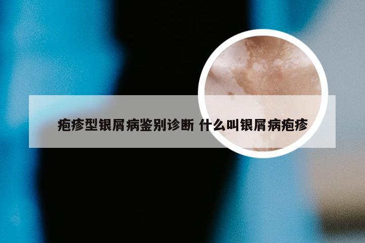 疱疹型银屑病鉴别诊断 什么叫银屑病疱疹