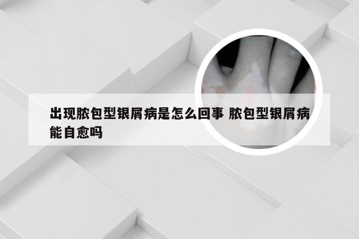 出现脓包型银屑病是怎么回事 脓包型银屑病能自愈吗