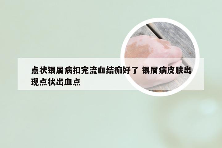 点状银屑病扣完流血结痂好了 银屑病皮肤出现点状出血点