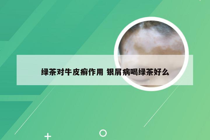 绿茶对牛皮癣作用 银屑病喝绿茶好么