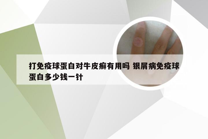 打免疫球蛋白对牛皮癣有用吗 银屑病免疫球蛋白多少钱一针