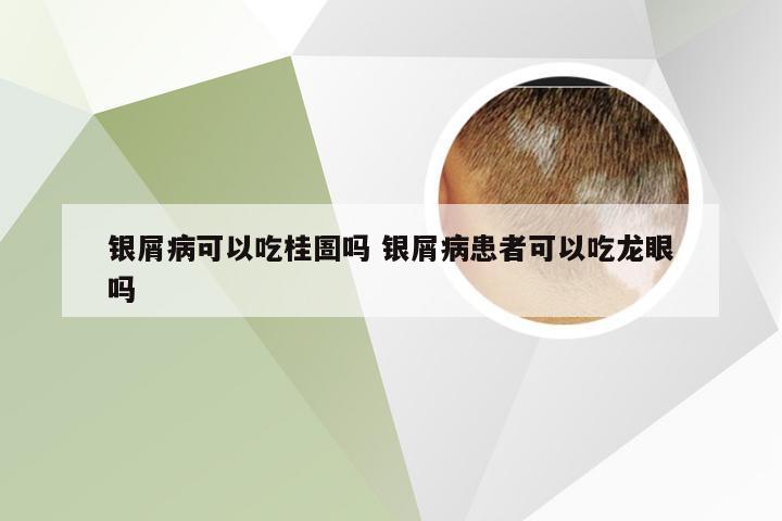 银屑病可以吃桂圄吗 银屑病患者可以吃龙眼吗