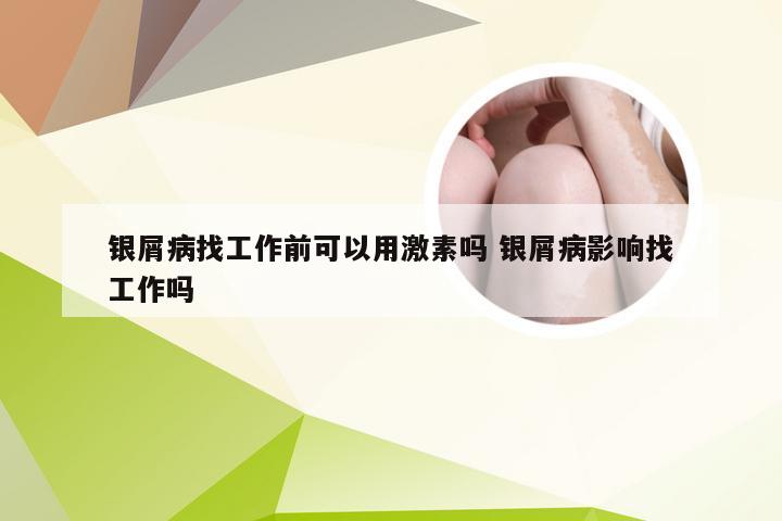 银屑病找工作前可以用激素吗 银屑病影响找工作吗