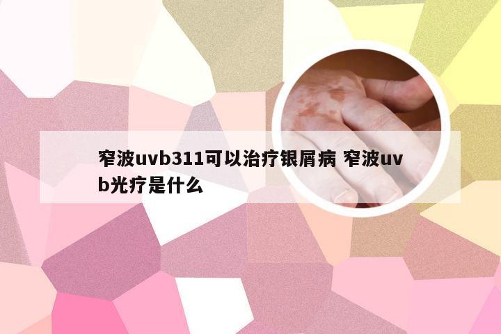 窄波uvb311可以治疗银屑病 窄波uvb光疗是什么