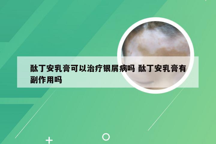 酞丁安乳膏可以治疗银屑病吗 酞丁安乳膏有副作用吗