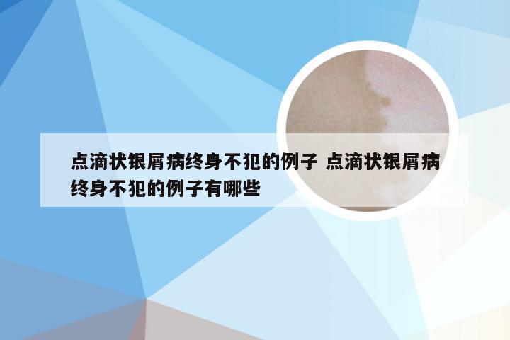 点滴状银屑病终身不犯的例子 点滴状银屑病终身不犯的例子有哪些