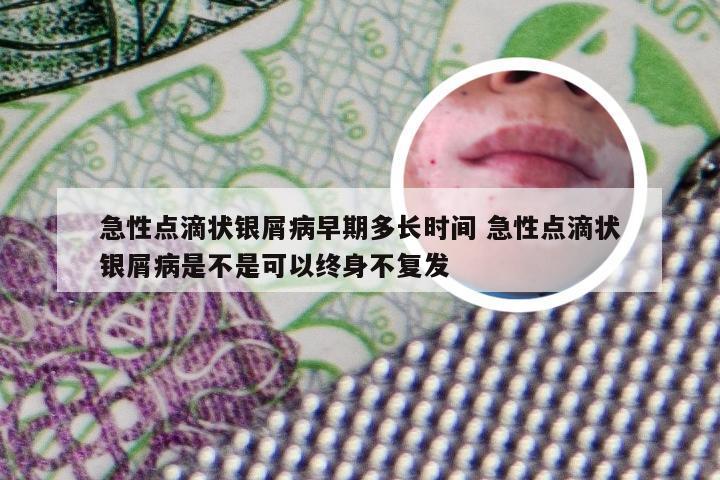 急性点滴状银屑病早期多长时间 急性点滴状银屑病是不是可以终身不复发