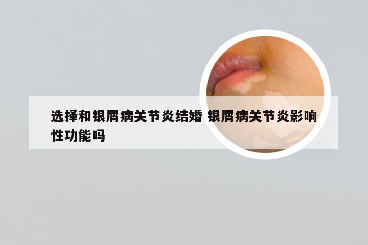 选择和银屑病关节炎结婚 银屑病关节炎影响性功能吗