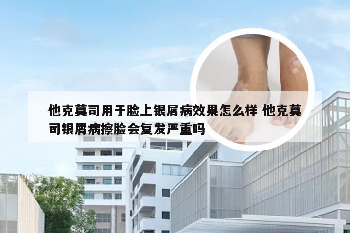 他克莫司用于脸上银屑病效果怎么样 他克莫司银屑病擦脸会复发严重吗