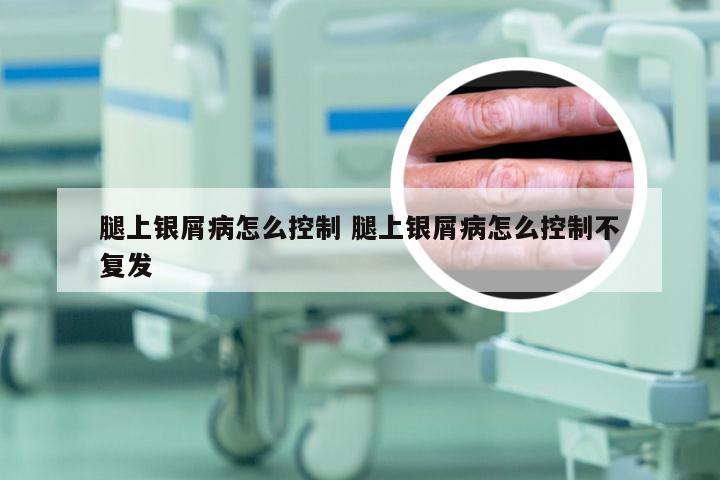 腿上银屑病怎么控制 腿上银屑病怎么控制不复发