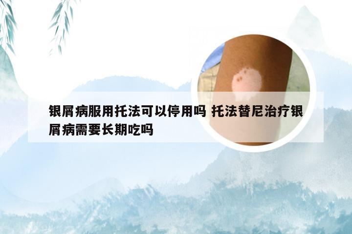 银屑病服用托法可以停用吗 托法替尼治疗银屑病需要长期吃吗