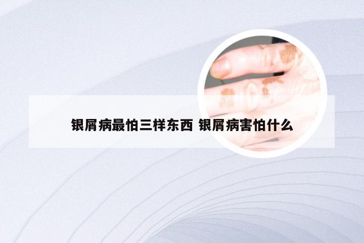 银屑病最怕三样东西 银屑病害怕什么