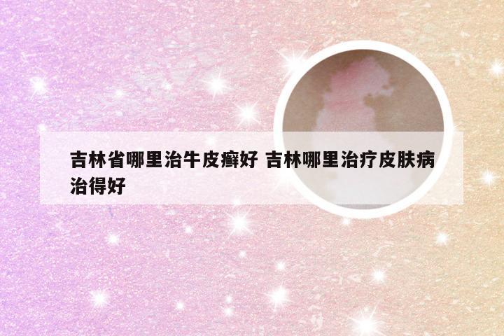 吉林省哪里治牛皮癣好 吉林哪里治疗皮肤病治得好