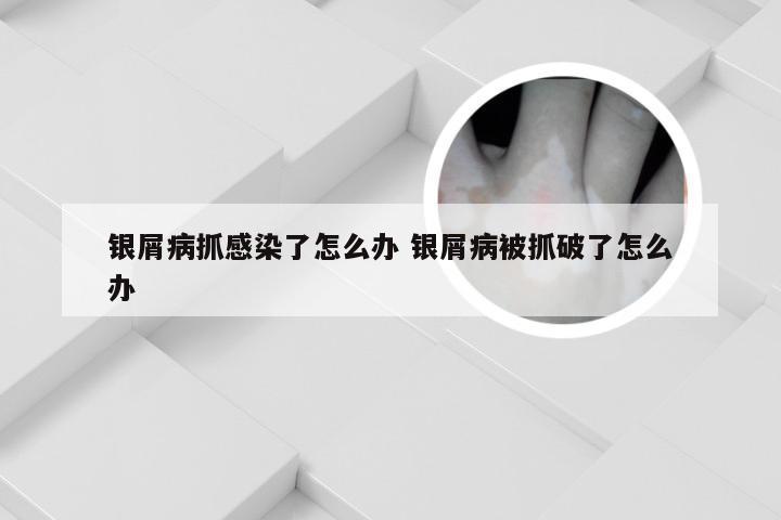 银屑病抓感染了怎么办 银屑病被抓破了怎么办