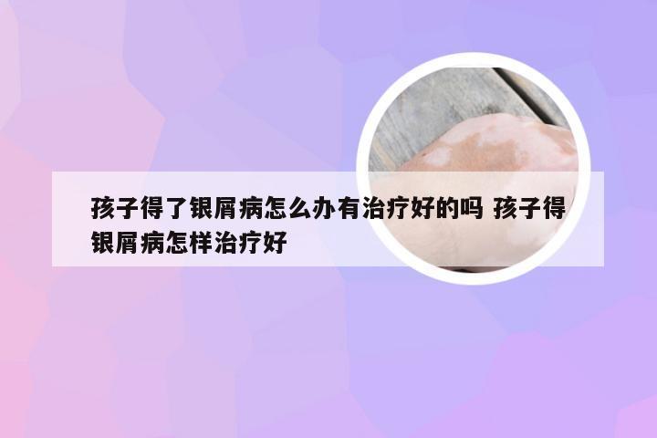 孩子得了银屑病怎么办有治疗好的吗 孩子得银屑病怎样治疗好