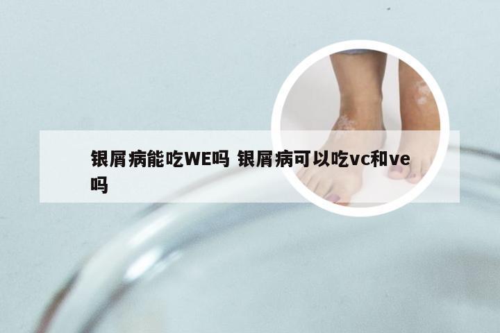 银屑病能吃WE吗 银屑病可以吃vc和ve吗