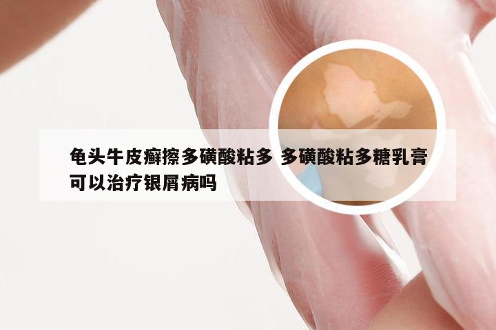 龟头牛皮癣擦多磺酸粘多 多磺酸粘多糖乳膏可以治疗银屑病吗