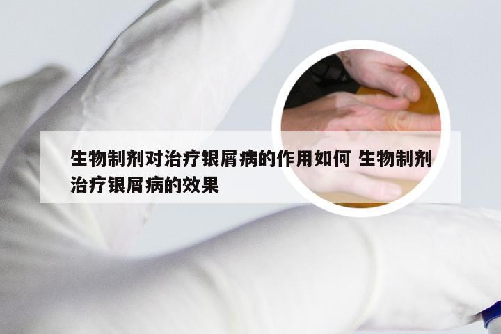 生物制剂对治疗银屑病的作用如何 生物制剂治疗银屑病的效果