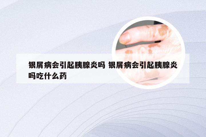 银屑病会引起胰腺炎吗 银屑病会引起胰腺炎吗吃什么药