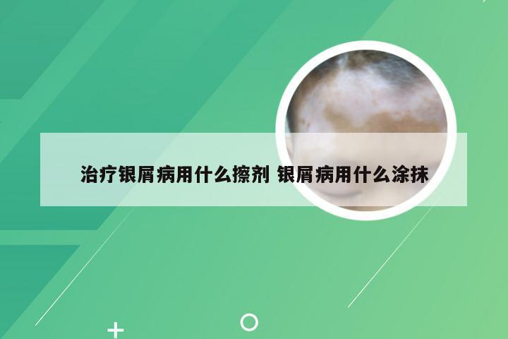 治疗银屑病用什么擦剂 银屑病用什么涂抹