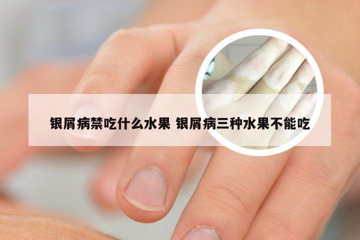 银屑病禁吃什么水果 银屑病三种水果不能吃