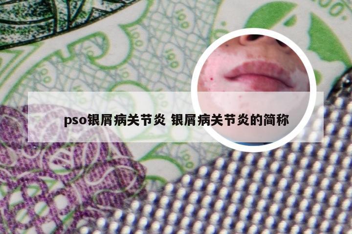 pso银屑病关节炎 银屑病关节炎的简称