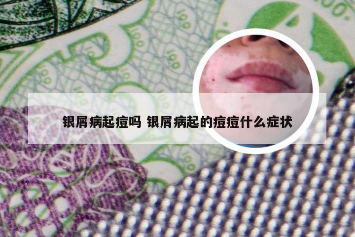 银屑病起痘吗 银屑病起的痘痘什么症状