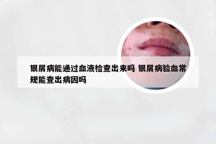 银屑病能通过血液检查出来吗 银屑病验血常规能查出病因吗