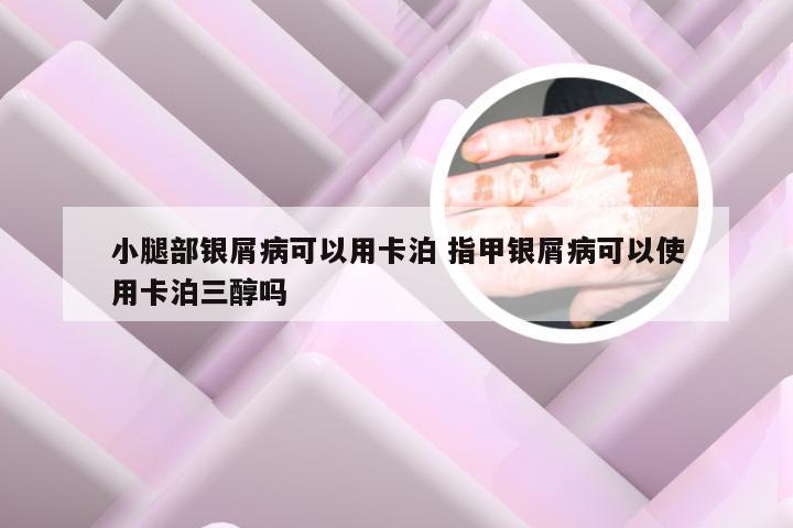 小腿部银屑病可以用卡泊 指甲银屑病可以使用卡泊三醇吗