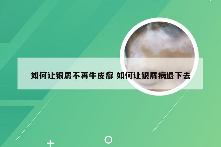 如何让银屑不再牛皮癣 如何让银屑病退下去