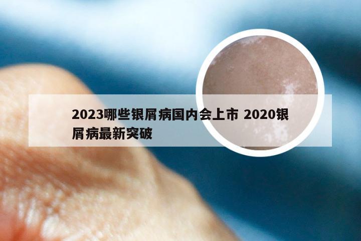 2023哪些银屑病国内会上市 2020银屑病最新突破