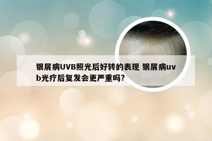 银屑病UVB照光后好转的表现 银屑病uvb光疗后复发会更严重吗?