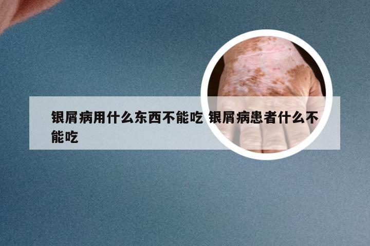 银屑病用什么东西不能吃 银屑病患者什么不能吃