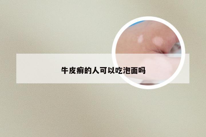 牛皮癣的人可以吃泡面吗