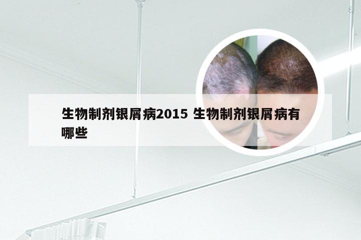 生物制剂银屑病2015 生物制剂银屑病有哪些